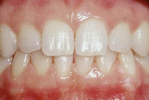Une gencive saine est rose, adhère à la dent et ne saigne pas.