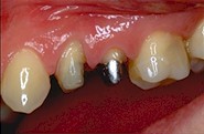 Les dents sont préparées avec les deux techniques de reconstitution décrites plus haut.