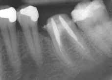 Radiographie d'une molaire avec les vis en place.