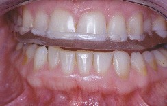 Les dents du haut et du bas ne peuvent plus entrer en contact.