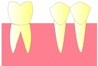 Une dent doit être extraite, il s'agit ici de la première molaire.