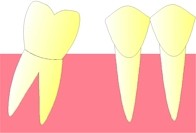 La dent se trouvant en arrière de la dent extraite, commence à se coucher vers l'avant (version).