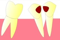 Cette accumulation d'aliments et de bactéries pourra provoquer une perte de l'os qui soutient la dent (atteinte parodontale).