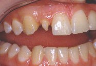 Incisive latérale atteinte de microdontie (dent naine).