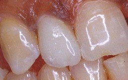 Dent atteinte de microdontie reconstituée par une facette.