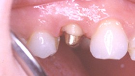Après cicatrisation, le dentiste peut reconstituer la dent avec un inlay-core et une couronne.