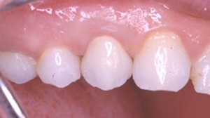 Après cicatrisation, le dentiste peut reconstituer la dent avec un inlay-core et une couronne.
