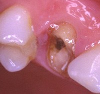 Après nettoyage et suppression des parties fragiles, on peut remarquer que la structure résiduelle dentaire est sous le niveau de la gencive. 