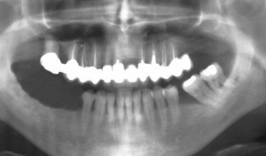 Trois dents sont manquantes au maxillaire inférieur.