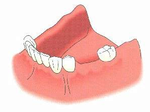 Remplacement de plusieurs dents manquantes par un bridge sur implants (évite l'appareil amovible) (dessins Nobel Biocare)