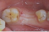 Réduction à minima des dents voisines de la dent manquante.