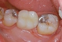Les ailettes sont collées sur la face linguale des dents.
