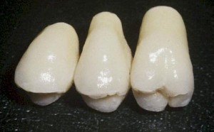 Le bridge joue un double rôle : il couronne les dents abîmées et remplace la dent manquante.