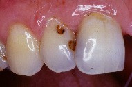 Restauration au composite dans le cas d'une dent antérieure.