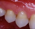 Dent traitée avec du composite.