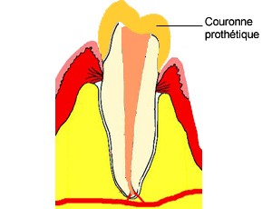 Habituellement la dent est ensuite couronnée. Le canal étant complètement obturé, les bactéries éliminées, la dent ne posera pas de problème infectieux, même plusieurs années après.