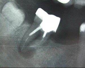 Cette dent couronnée depuis plusieurs année présente une importante lésion à l'extrémité de la racine. <br>Cette lésion est restée silencieuse et a été découverte fortuitement lors d'un examen radiologique.