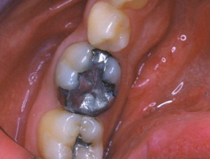Cette dent dévitalisée présente une grosse reconstitution avec un amalgame. Le patient a ressenti une vive douleur au cours d'un repas.