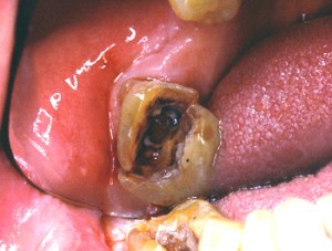 Voici un autre cas de fracture de dent dévitalisée. Cette dent devra être extraite.