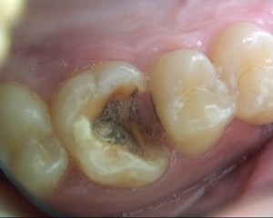 Sur cette dent il y avait une gros amalgame.