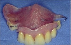 Plaque de résine plus ou moins volumineuse selon le nombre de dents à remplacer. Sa tenue est assurée par des crochets en fil métallique.