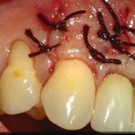 La greffe gingivale