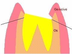 L’élongation coronaire