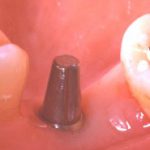 Qu’est-ce-qu’un implant ?
