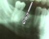 <i class="fa fa-video-camera" aria-hidden="true"></i> Implants dentaires : le film de l’aventure implantaire en vidéo