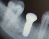 Implants dentaires : vos questions, nos réponses