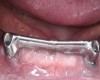 <i class="fa fa-video-camera" aria-hidden="true"></i> Barre de rétention sur 2 implants