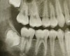 <i class="fa fa-video-camera" aria-hidden="true"></i> Dent de sagesse et orthodontie