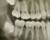 <i class="fa fa-video-camera" aria-hidden="true"></i> Dent de sagesse et orthodontie
