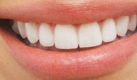<i class="fa fa-video-camera" aria-hidden="true"></i>  Le blanchiment des dents. Un sourire éclatant de blancheur est à notre époque signe de santé, de jeunesse et de beauté. C’est un argument incontournable de séduction.