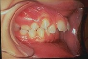 Dents en avant : les conséquences de la tétine - Dentiste pour Enfants
