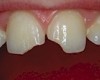 Dents fracturées : les collages