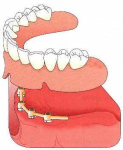 La prothèse amovible - Dentalespace
