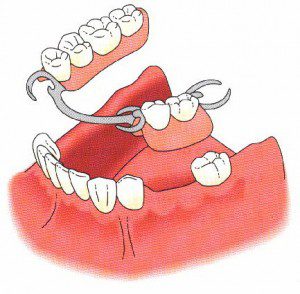 Comment manger avec de fausses dents ? - Dent Provisoire