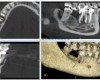 Le Cone Beam ou CBCT (pour Cone Beam Computed Tomography)