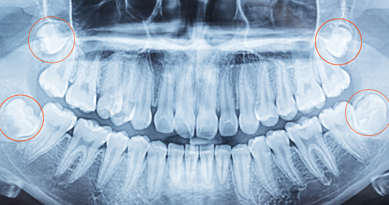 Photo d'une radiographie de dents de sagesse.