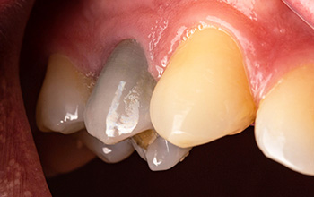 Tout savoir sur les dents dévitalisées