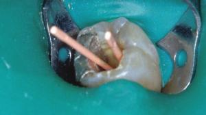 Démystifions la pose de digue - Endodontie