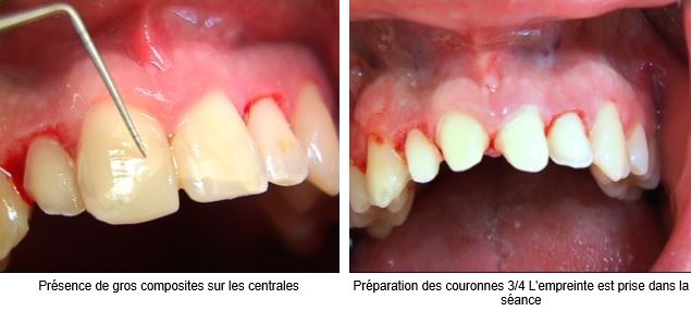 05_4couronnes tout ceram