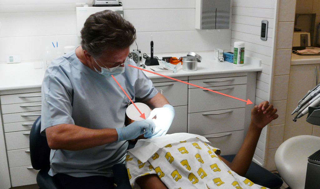 Avulsion sous hypnose ; bras gauche de la patiente en catalepsie (Dr Revise)