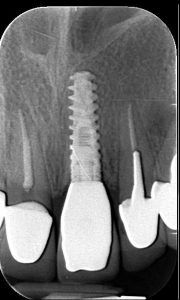 Contrôle radiol 21 - Implant ALPHABIO NEO