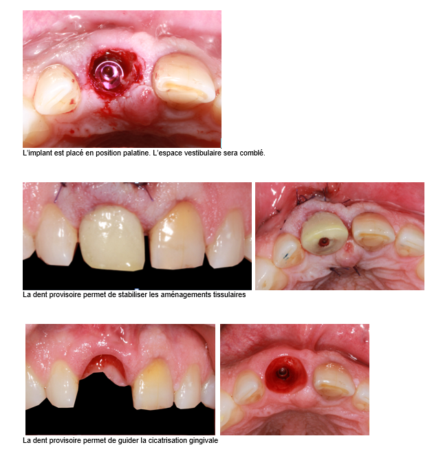 Extraction implantation et provisoire immédiates