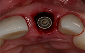 Extraction-implantation