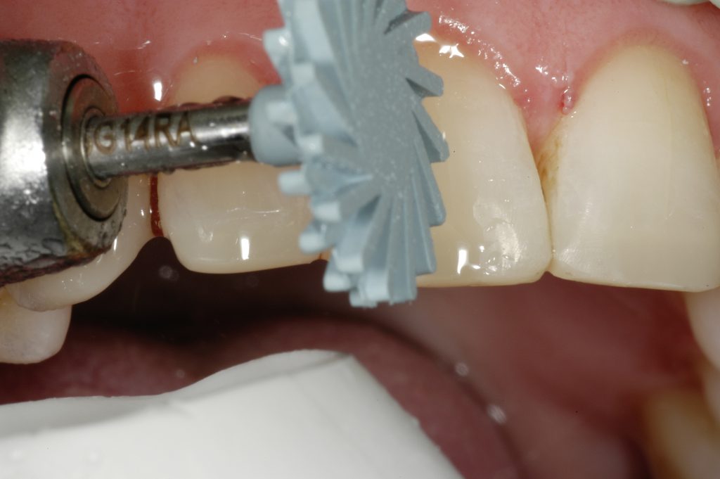 Fig.13 : Polissage avec le polissoirs DIATECH ShapeGuard (Coltène)