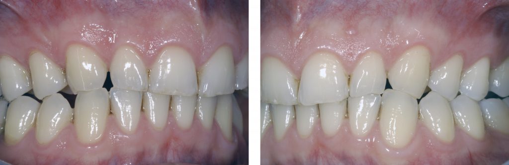 Fig.2 : Latérotrusion vers la droite : perte de guidage sur cuspides en latérotrusion en faveur des groupes latéral et antérieur. Fig.3 : La situation identique sur le côté gauche. 