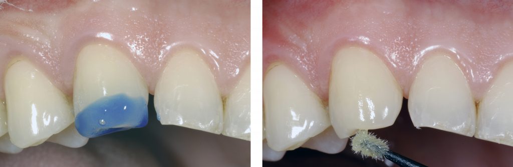 Fig. 4 : Mordançage sélectif pendant 30 s de l’émail avec un gel à base d’acide phosphorique à 35 % (Etchant Gel S, COLTENE) Fig.5 : Massage de 20 s avec l’adhésif ONE COAT 7 UNIVERSAL